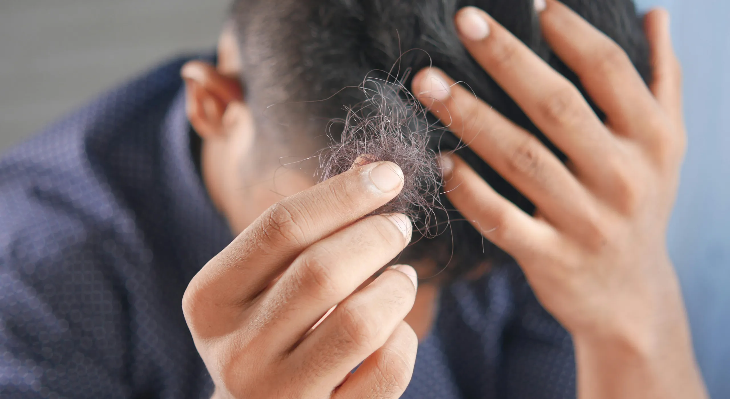 Androgenetická alopecie: Alternativou může být perorální minoxidil